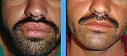 Lip Reduction surgery | Lip Augmentation in Toronto | Solomon Facial Plastic