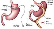 Website at https://www.researchgate.net/profile/Titte-Srinivas/publication/290995369_Gastric_bypass_oxalosis_in_renal...