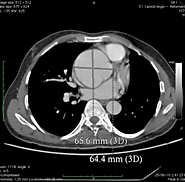 Aortic Surgery in Delhi, India | Aortic Aneurysm Surgery Cost in Delhi