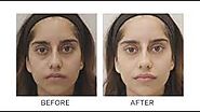 Nose surgery Vancouver | Nose Reshaping | Plastic Surgery
