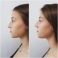 Nose surgery Vancouver - 8 West Cosmetic Surgery Clinic BC