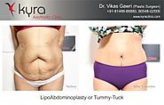Tummy Tuck Surgery in Vancouver, Abdominoplasty in Vancouver