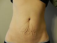 Vancouver Abdominoplasty / Tummy Tuck, Fairview Plastic Surgery