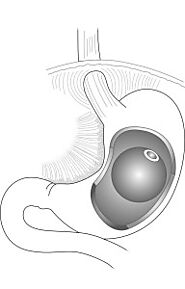 Gastric Balloon Surgery - GastricBand.Clinic