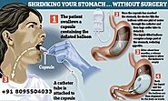 Website at http://www.gastricband.clinic/gastric-balloon/gastric-balloon-surgery/