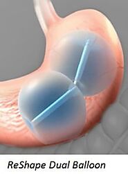 Gastric Balloon: Options, Everything You Need to Know - Bariatric Journal