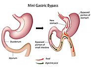 Website at https://www.whatclinic.com/bariatric-surgery/canada