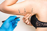 Brachioplasty (Arm Lift) - Plastic Surgery in Calgary
