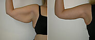 Arm Lift (Brachioplasty) | Radiance Plastic Surgery | Canmore | Calgary