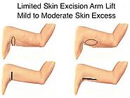 Arm Lift surgery in Calgary, Plastic Surgery Associates