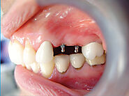 Pros and Cons of Mini Dental Implants vs Traditional Dental Implants