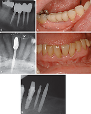 The Mini Dental Implant in Fixed and Removable Prosthetics: A Review | Journal of Oral Implantology