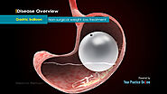 Gastric Balloon Surgery Video | Weight Loss Surgery