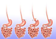 What You Should Know About Gastric Sleeve Surgery