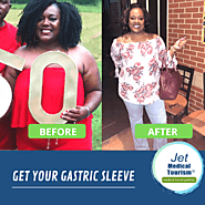 Gastric Sleeve Before and After Pictures: Best VSG Photos (2021)