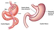 Website at https://myhealth.alberta.ca/health/Pages/conditions.aspx?hwid=hw252781