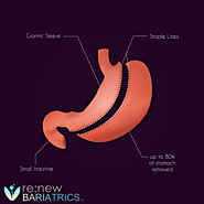 Gastric Sleeve vs. Gastric Bypass: Best Comparison, Pros and Cons