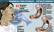 Gastric Sleeve Surgery