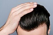 Are Hair Transplant Results Permanent?