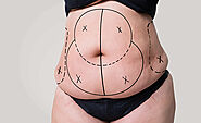 How Long Does Tummy Tuck Surgery Take?