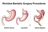 Gastric Sleeve Surgery Revision, Conversion: Re-Sleeve, Mini Bypass, Bypass, DS