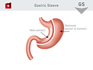 Gastric Sleeve Abroad - KCM Clinic