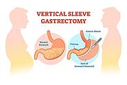 Best Murfreesboro TN Sleeve Gastrectomy | Medical Weight Loss