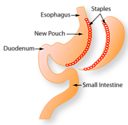 Gastric Sleeve Surgery - Bariatric Journal