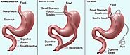 Gastric Sleeve in Guadalajara, Mexico • Check Prices & Reviews