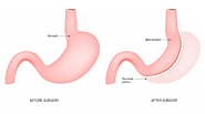 Gastric Sleeve Surgery Vs. Gastric Plication: Procedure Comparison