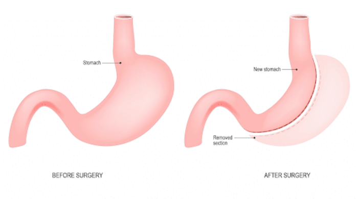 Gastric Sleeve Surgery in Querétaro | A Listly List