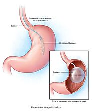 Bariatric weight loss nonsurgical - gastric balloon in Mexico City