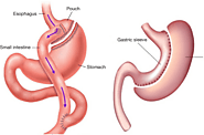 Gastric Sleeve Surgery for Rapid Weight Loss by Bariatric Surgeon Dr. Moein