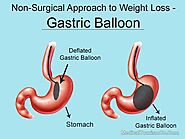 Gastric Balloon in Cancun – Mexico