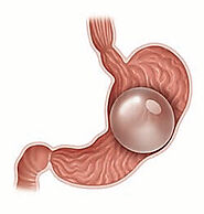 Bowel obstruction due to the migration of the deflated intragastric balloon, a rare and potentially lethal complication