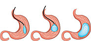 Gastric balloon in Mexico | The BEST 8 clinics ▷‎ Prices 2021