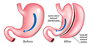 Conversion to Roux-en-Y gastric bypass surgery through a robotic-assisted hybrid technique after failed sleeve gastre...