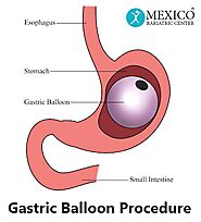 Gastric Balloon in Mexico - Non Surgical Weight Loss System $3,695