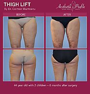 Thigh Lift surgery | Dr Carmen Munteanu Plastic Surgeon