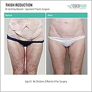 Thigh Lift Melbourne | Thigh Reduction Surgery Melbourne | Coco Ruby PS