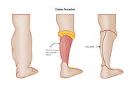 Lymphedema Treatment Costs Vancouver Island BC | CLR Healthcare | CLR Healthcare Vancouver Island BC