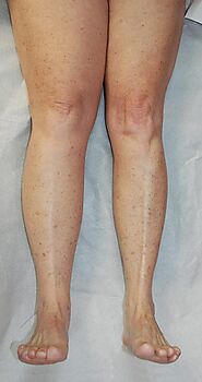 Lymphedema Surgery In Parksville, canada