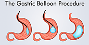 Bariatric weight loss nonsurgical - gastric balloon in Nuevo Laredo
