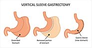 Gastric Sleeve Surgery – Hospital BC
