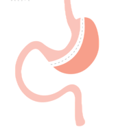 Gastric Sleeve Surgery in Tijuana, Mexico | VIDA Bariatrics