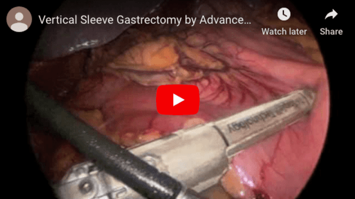 Gastric Sleeve Surgery in Tijuana, Mexico, Dr. Fok Russell