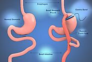 Average Monthly Weight Loss after Gastric Sleeve Surgery