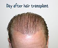 Hair Restoration in Calgary | Prime Hair Clinic