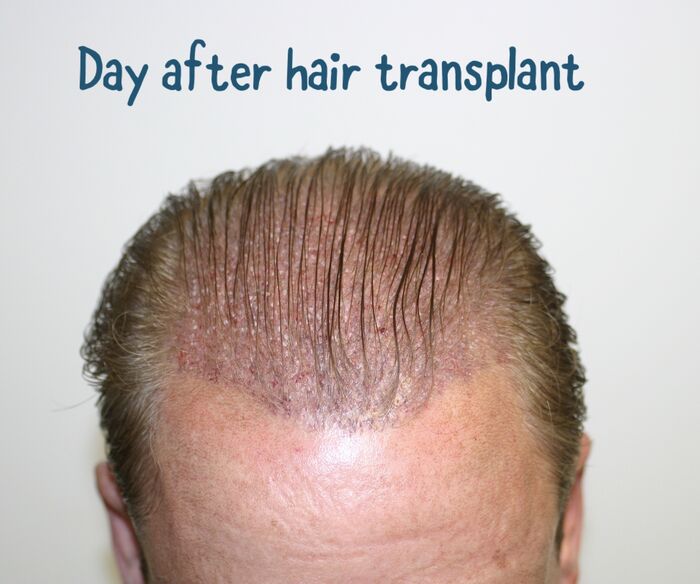 Hair Transplant In Calgary A Listly List