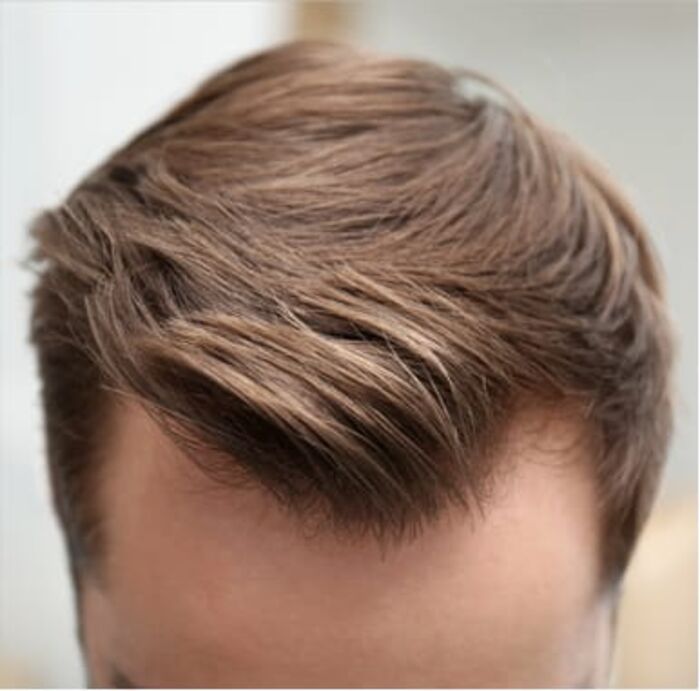 Hair Transplant In Calgary A Listly List